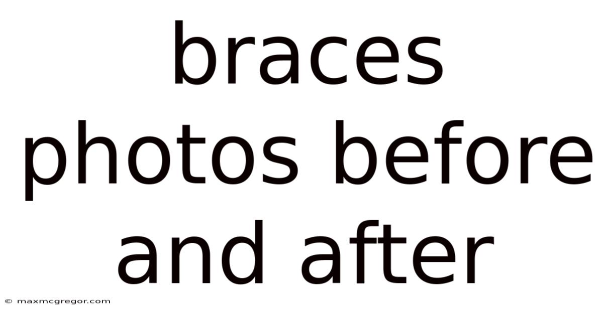 Braces Photos Before And After